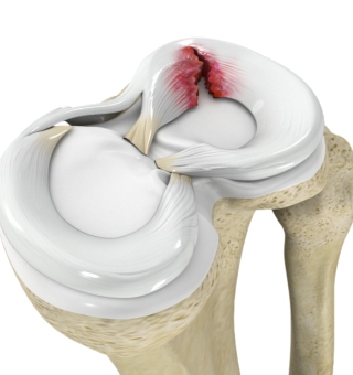 Back on the Slopes: A Patient’s Return to Outdoor Activities After a Meniscus Tear