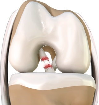 How ONS Got High School Teammates Back on the Field After ACL Tears